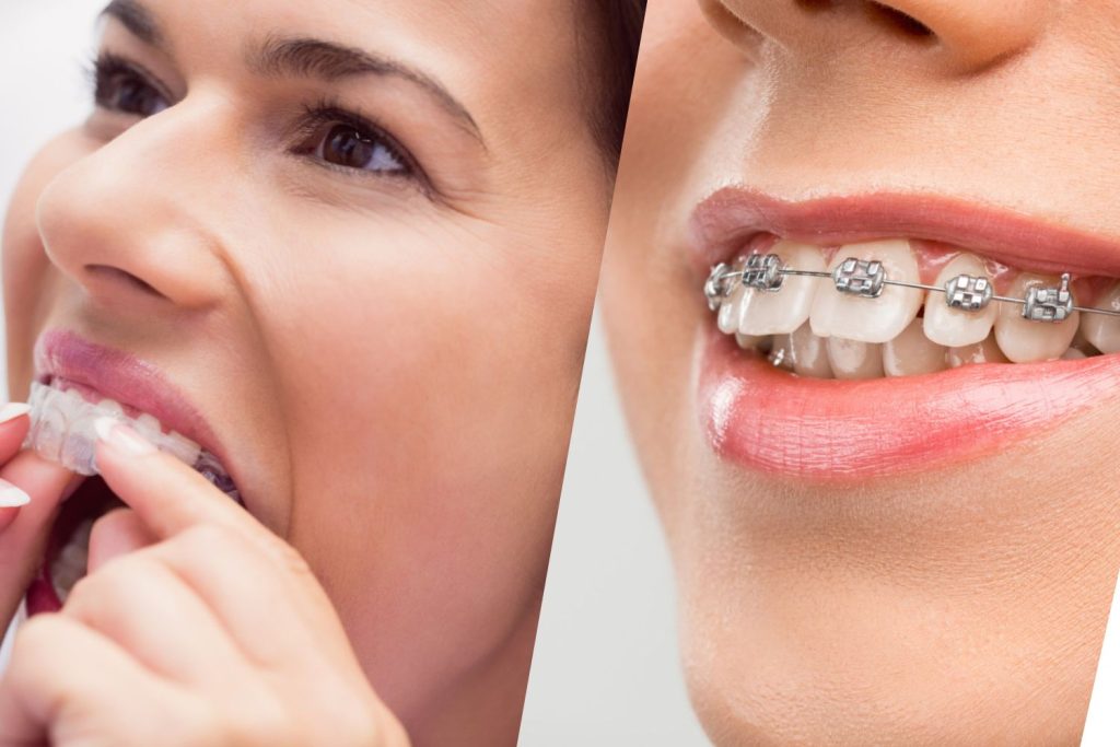Invisalign vs. Traditional Braces What San Diego Dentists